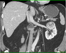 Renal Cell Carcinoma - CTisus CT Scan