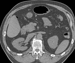 Renal Cell Carcinoma - CTisus CT Scan