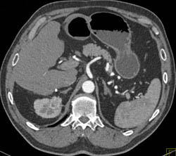 Renal Cell Carcinoma - CTisus CT Scan