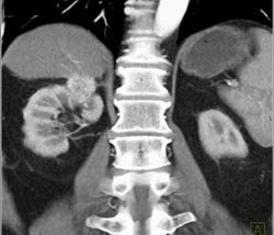 Renal Cell Carcinoma - CTisus CT Scan