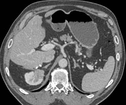 Renal Cell Carcinoma - CTisus CT Scan