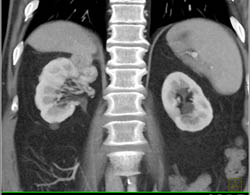 Renal Cell Carcinoma - CTisus CT Scan