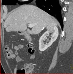 Renal Cell Carcinoma - CTisus CT Scan