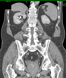 Renal Cell Carcinoma - CTisus CT Scan