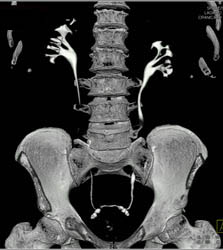 Renal Cell Carcinoma - CTisus CT Scan