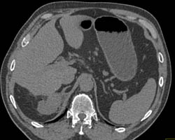 Renal Cell Carcinoma - CTisus CT Scan