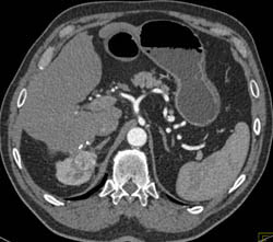 Renal Cell Carcinoma - CTisus CT Scan