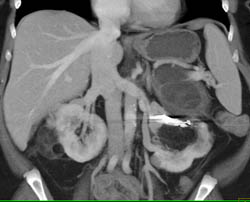 Bilateral Renal Angiomyolipoma - CTisus CT Scan