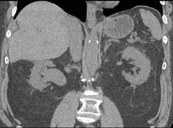 Transitional Cell Carcinoma of the Right Renal Pelvis in Multiple Views. Note Delayed Function of Right Kidney - CTisus CT Scan