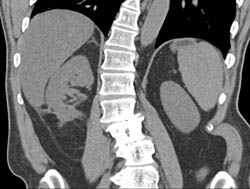 Post Radiofrequency Ablation (RFA) Changes in Right Kidney - CTisus CT Scan