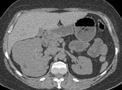 Renal Cell Carcinoma - CTisus CT Scan