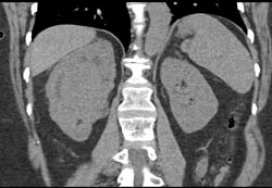 Renal Cell Carcinoma - CTisus CT Scan