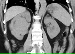 Renal Cell Carcinoma - CTisus CT Scan