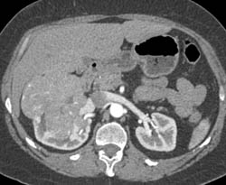 Renal Cell Carcinoma - CTisus CT Scan