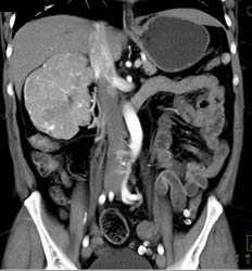 Renal Cell Carcinoma - CTisus CT Scan