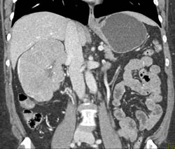 Renal Cell Carcinoma - CTisus CT Scan