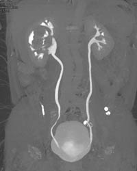 Renal Cell Carcinoma - CTisus CT Scan