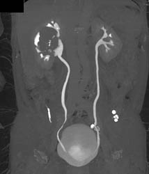 Renal Cell Carcinoma - CTisus CT Scan