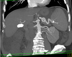 Renal Cell Carcinoma - CTisus CT Scan