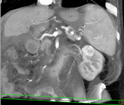 Renal Cell Carcinoma - CTisus CT Scan