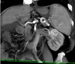 Renal Cell Carcinoma - CTisus CT Scan