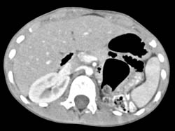 Pelvic Kidney - CTisus CT Scan