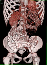 Pelvic Kidney - CTisus CT Scan