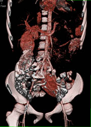 Pelvic Kidney - CTisus CT Scan