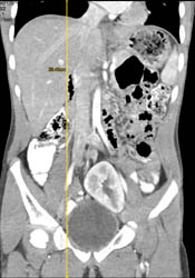 Pelvic Kidney - CTisus CT Scan