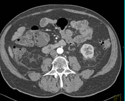 Renal Cell Carcinoma Metastatic to the Duodenum - CTisus CT Scan