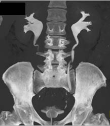 Dilated Renal Pelvis Bilaterally on CT Urogram - CTisus CT Scan