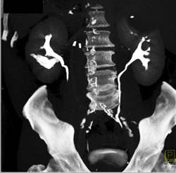 Leak Post Radiofrequency Ablation (RFA) on Late Phase Images - CTisus CT Scan