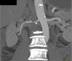 Renal Artery Stenosis - CTisus CT Scan