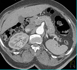 Left Nephrectomy With Spleen Rotating Into Renal Bed - CTisus CT Scan