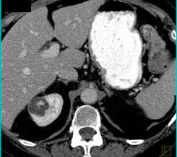 Complex Cystic Lesion - CTisus CT Scan