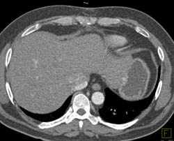 Metastatic Renal Cell Carcinoma to Nodes - CTisus CT Scan