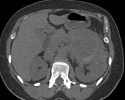 Lymphoma With Perirenal Spread of Tumor in Left Perirenal and Pararenal Space - CTisus CT Scan