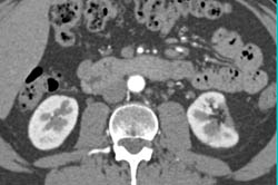 Old Renal Infarction With Scarring - CTisus CT Scan