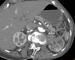 Transitional Cell Carcinoma - CTisus CT Scan