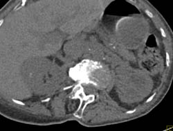 Transitional Cell Carcinoma - CTisus CT Scan