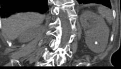 Transitional Cell Carcinoma - CTisus CT Scan