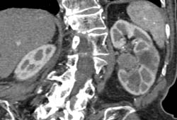 Transitional Cell Carcinoma - CTisus CT Scan