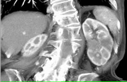 Transitional Cell Carcinoma - CTisus CT Scan