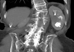 Transitional Cell Carcinoma - CTisus CT Scan