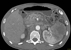 Renal Cell Carcinoma - CTisus CT Scan