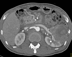 Renal Cell Carcinoma - CTisus CT Scan