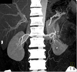 Renal Cell Carcinoma - CTisus CT Scan