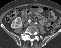 2 Cm Renal Cell Carcinoma With Multiple Phases - CTisus CT Scan