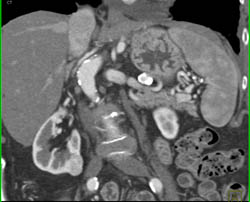 2 Cm Renal Cell Carcinoma With Multiple Phases - CTisus CT Scan