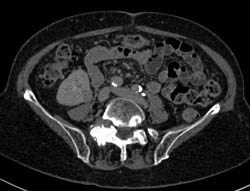 2 Cm Renal Cell Carcinoma With Multiple Phases - CTisus CT Scan